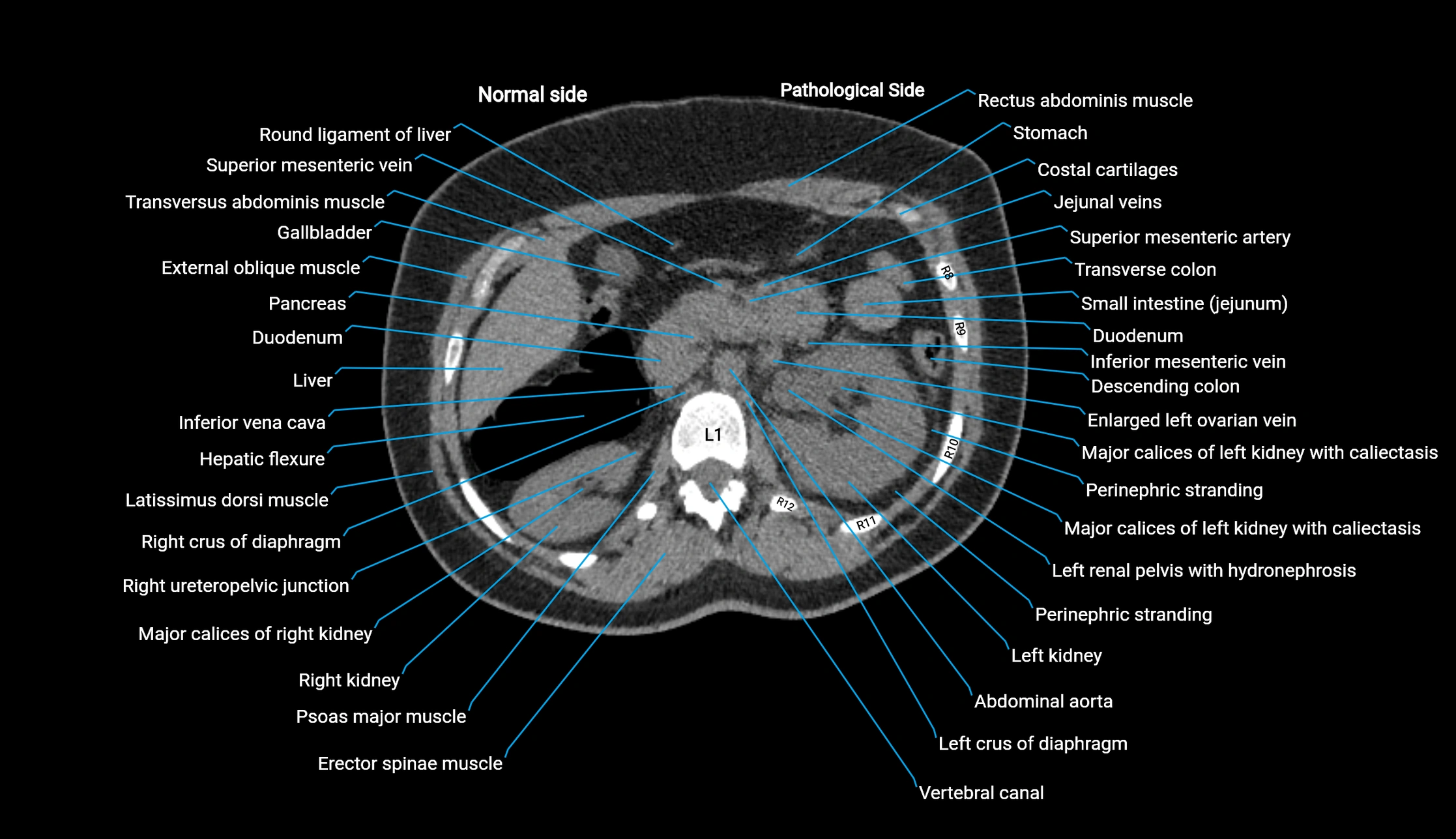 CT KUB axial cross sectional anatomy  radiology image -img-00201-00040.webp